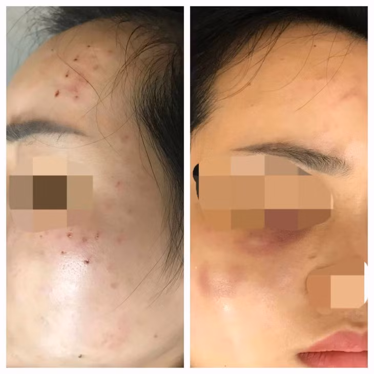 Nguoi phu nu di lam dep bi chu spa tiem “nham” sua rua mat