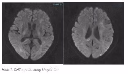 Tuong dot quy, khong ngo viem nao tu mien the hiem gap