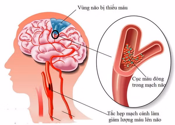 Dau hieu cua thieu mau nao, dung chu quan dot quy nhu choi