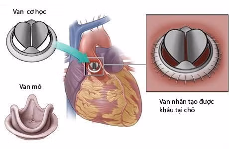 Dung tieu soi huyet cuu benh nhan ket van tim nhan tao