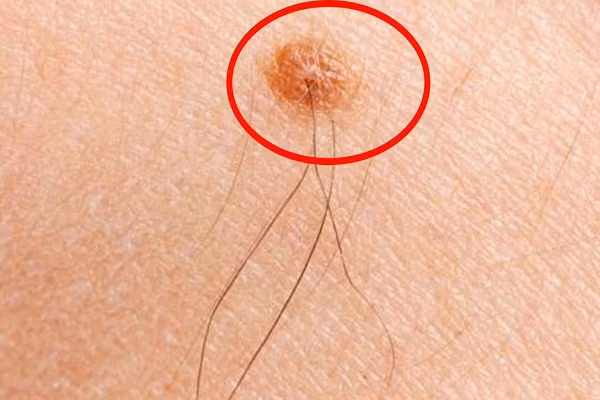 Lông mọc trên nốt ruồi. Không kể là nam hay nữ, nếu trên nốt ruồi có lông mọc thì đều là điềm lành, báo tài lộc. Tuy nhiên, người xưa có câu: ''Một lông cô quạnh, ba lông chủ phát tài".