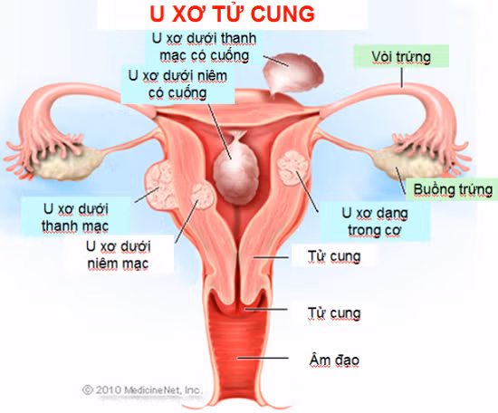 U xơ cổ tử cung là một loại u xơ phát triển từ trong cổ tử cung của người phụ nữ. Đó thường là những khối u nhỏ và lành tính.
