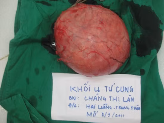 Tại Việt Nam, các bác sĩ cũng đã phẫu thuật thành công cắt bỏ khối u xơ tử cung nặng gần 4kg của bà Chàng Thị Làn, Hà Giang vào năm 2011.