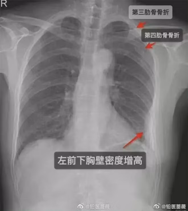 Cô gái gãy 3 xương sườn sau cái ôm của đồng nghiệp Co gai gay 3 xuong suon sau cai om cua dong nghiep