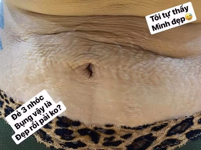 Khi mang bầu bé thứ hai, diễn viên Hải Băng lơ là việc dưỡng da nên da bị rạn khá nhiều. Chưa kịp hồi phục, ba tháng sau khi vượt cạn, cô mang thai bé thứ ba, khiến tình trạng da rạn nứt, chảy xệ khá nặng. Mỗi khi soi gương, Hải Băng không tránh khỏi sự buồn chán nhưng nghĩ tới ba thiên thần bé bỏng, cô học cách chấp nhận cơ thể, xem những vết rạn da như một phần của hành trình làm mẹ thiêng liêng.