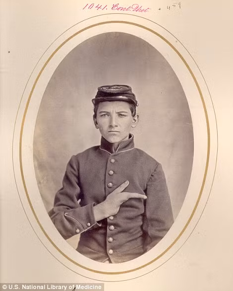 Binh nhì Robert Fryer phải cắt cụt 3 ngón tay ở bàn tay phải sau trận chiến Hatcher's Run, Virginia.
