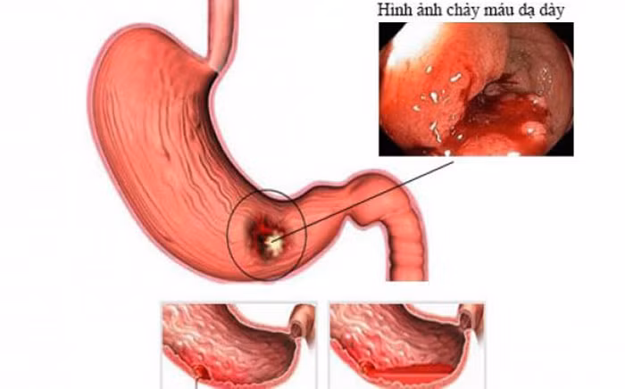 Sau một đêm không ngủ để làm điều này, vợ trẻ nôn ra máu phải cấp cứu Sau mot dem khong ngu de lam dieu nay, vo tre non ra mau phai cap cuu