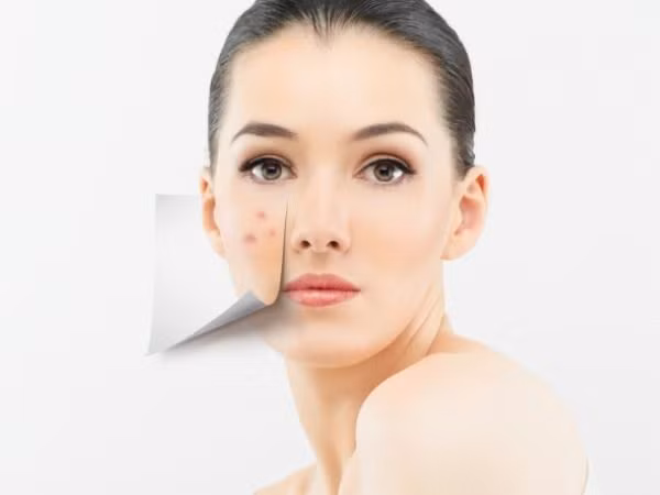 Nếu tình trạng da mụn trứng cá bị quá nghiêm trọng, hãy nhờ đến sự giúp đỡ của các bác sĩ da liễu. Nếu không, viêm da mụn có thể để lại những vết sẹo rỗ nghiêm trọng.