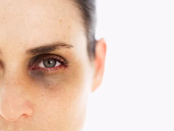 Quầng thâm dưới mắt. Căn bệnh này có thể là do di truyền, nhưng nó cũng có thể bị gây ra do quá trình lão hóa, thiếu ngủ, thiếu chất dinh dưỡng và ảnh hưởng nội tiết...