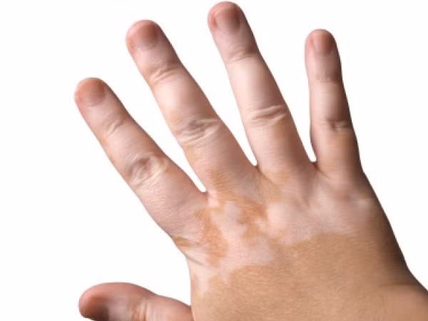 Bệnh bạch biến. Bạch biến là một bệnh mất sắc tố ở da, lông, tóc. Tỉ lệ mắc bệnh khoảng 1-2% dân số, người da màu mắc bệnh nhiều hơn da trắng. Bệnh có ở mọi lứa tuổi nhưng thường ở người trẻ.