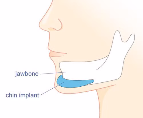 Độn cằm. Phẫu thuật độn cằm được biết đến là cách để có được một chiếc cằm nhọn, dài, thon gọn và hài hòa hơn. Độn cằm được thực hiện bằng cách rạch phần thịt ở dưới cằm và đưa phần độn vào lắp ráp bên trong. Nó có liên quan trực tiếp tới các phần quan trọng trên gương mặt, vì thế có thể dễ dàng xảy ra nguy hiểm.