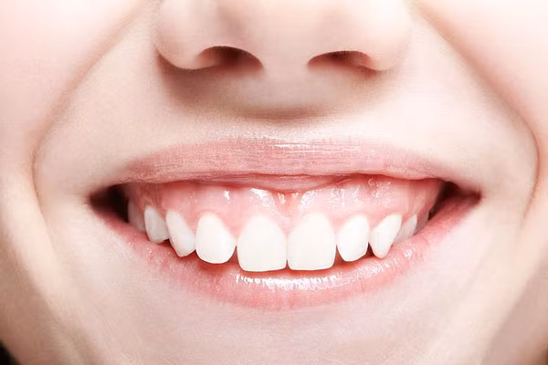 Cười hở lợi. Người phụ nữ cười hở lợi là người sống theo cảm tính. Làm việc gì cũng không nói trước khiến ai cũng không thể hiểu nổi. Người này hay tin người, thật thà, yếu đuối nên cũng không đề phòng được ai, nhất là đối với tình cảm thì rất dễ rơi vào lưới tình, yêu đương mù quáng, lận đận đường tình duyên vì họ hướng ngoại, phóng khoáng.
