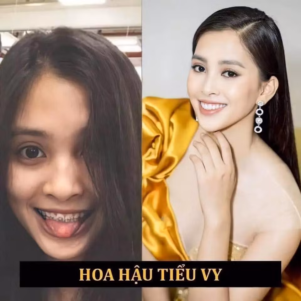 Nữ MC nổi tiếng "lột xác" sau 2 năm niềng răng - Hình 2 Nu MC noi tieng