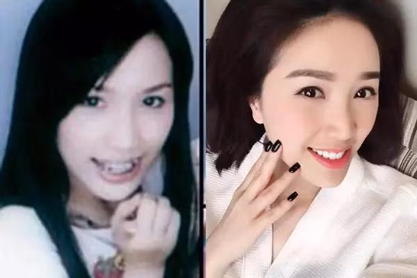 Nữ MC nổi tiếng "lột xác" sau 2 năm niềng răng - Hình 7 Nu MC noi tieng