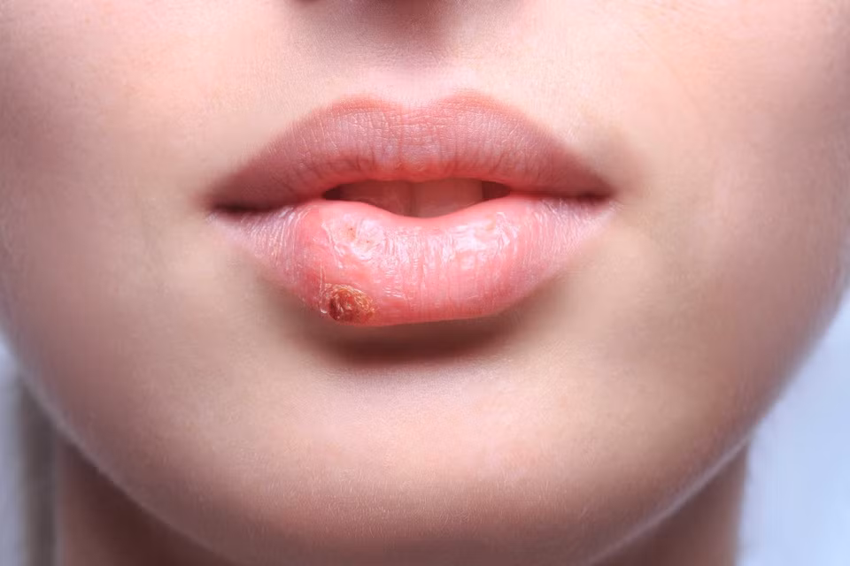 Chua khoi ung thu giai doan cuoi nho loai virus quen thuoc