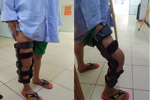 Chàng trai nhận tin ung thư xương sau 2 tháng đau khớp gối - Hình 2 Chang trai nhan tin ung thu xuong sau 2 thang dau khop goi-Hinh-2