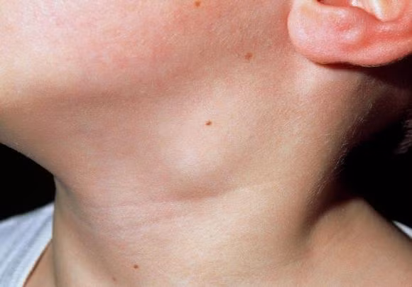 Sưng hạch ở cổ, nhất là những hạch có đường kính trên 1cm, coi chừng có khối u ác tính, nói chung ung thư dạ dày giai đoạn cuối và ung thư phổi rất dễ chuyển sang hạch cổ, hạch to, không đau. Các hạch này cũng không loại trừ khả năng bị ung thư hạch.