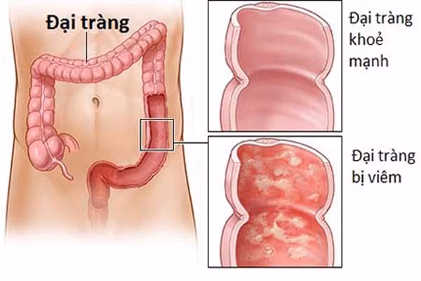 Ung thư ở mỗi vị trí trên khung đại tràng sẽ biểu hiện các triệu chứng khác nhau, thông thường nhất là có máu trong phân. Bệnh này, nếu không đi khám và phát hiện kịp thời thì sẽ rất khó chữa và nguy kiệt đến tính mạng.