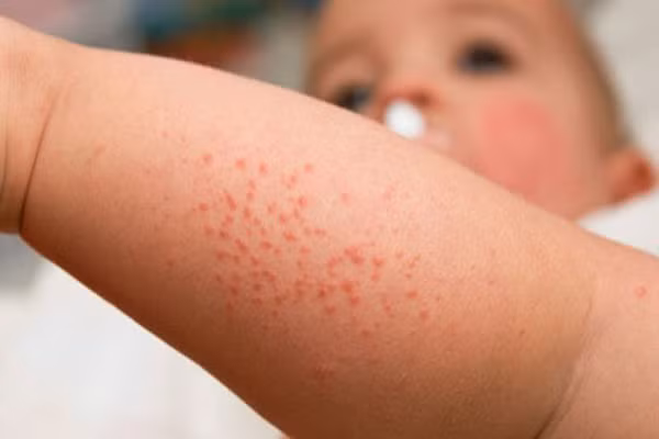 Đó có thể là dấu hiệu của bệnh Lyme hoặc rối loạn về máu. Nếu con xuất hiện kèm thêm các triệu chứng khác như hôn mê, kích động hoặc khó thở thì càng nguy hiểm hơn.