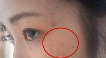 4 biểu hiện trên mặt chứng tỏ nữ giới bị viêm nhiễm phụ khoa - Hình 2 4 bieu hien tren mat chung to nu gioi bi viem nhiem phu khoa-Hinh-2