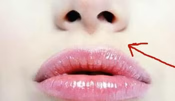 4 biểu hiện trên mặt chứng tỏ nữ giới bị viêm nhiễm phụ khoa - Hình 3 4 bieu hien tren mat chung to nu gioi bi viem nhiem phu khoa-Hinh-3