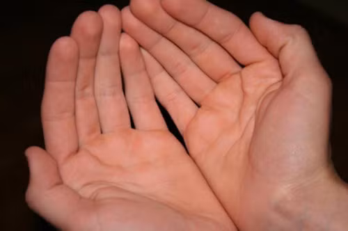 Không nên dùng kìm cắt những lớp da sần vì rất dễ gây tổn thương, chảy máu. Việc cắt da có thể kích thích lớp da non tái tạo và bị chai cứng nhanh hơn.