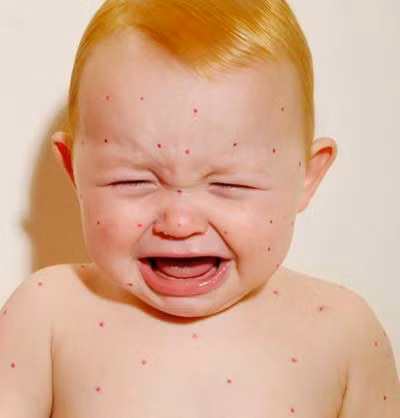 Phản ứng nhanh. Thường xảy ra đột ngột với các biểu hiện như ói mửa, thở khò khè, nổi ban đỏ, sưng phù mặt hay nặng hơn là toàn thân. Có những trẻ nhạy cảm với sữa đến mức chỉ cần đồ dùng dính một chút sữa cũng gây nên dị ứng.