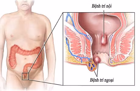 Chữa trĩ: Có thể dùng hạt gấc giã nát, thêm một ít giấm thanh, gói bằng vải, đắp vào hậu môn để suốt đêm. Mỗi đêm đắp thuốc một lần. Ảnh: benhtrihanoi.net.