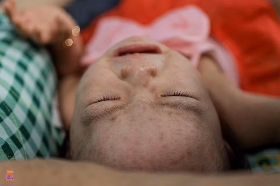 Các nốt phát ban đỏ trên trán, mặt, cổ... của một trẻ nhỏ mắc bệnh sởi.