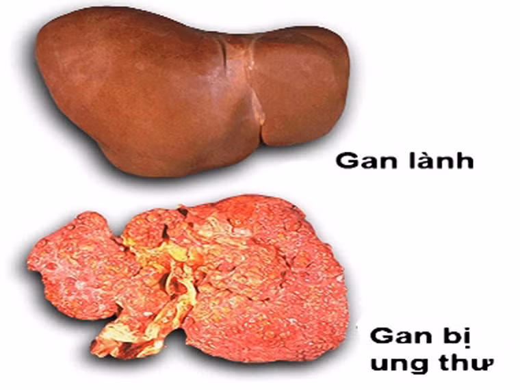 Ung thư gan. Ung thư gan thường tấn công nam giới nhiều hơn phụ nữ. Rất có thể bệnh bắt nguồn từ những tổn thương do nghiện rượu, dị tật bẩm sinh, nhiễm trùng mãn tính, xơ gan hoặc nhiễm vi rút viêm gan.