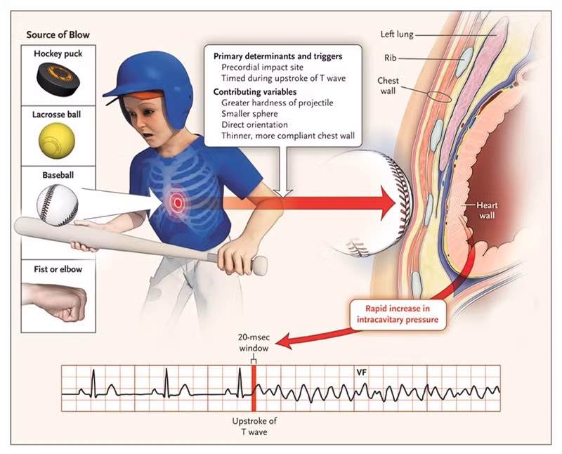 Có khoảng 125 trường hợp commotio cordis được ghi nhận, bao gồm một số cầu thủ hockey trẻ tử vong do bị đĩa tròn va đập vào ngực. Một số ý kiến cho rằng các cao thủ "điểm mạch" biết một cú đánh vào ngực có thể gây ra commotio cordis làm chết người. Tuy vậy, điều này không lý giải được việc có những người được cho là tử vong sau đó một thời gian dài.