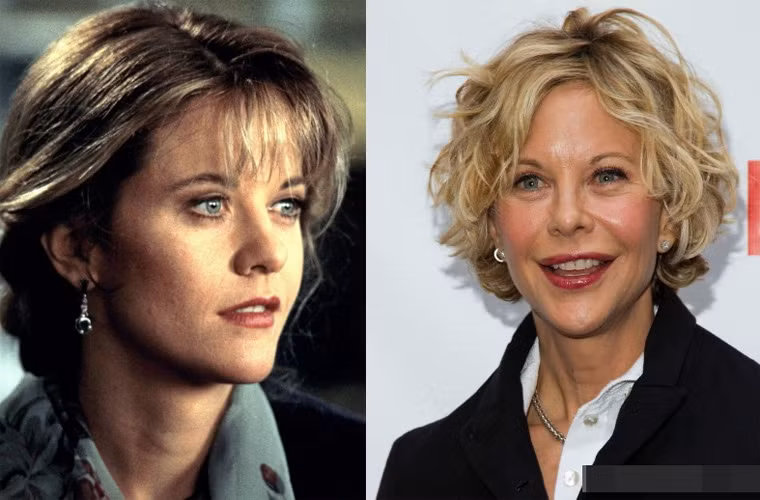 Những năm 1990, Meg Ryan sáng chói trên bầu trời Hollywood nhờ cả tài năng và sắc đẹp riêng có. Nhưng sau này, nhiều lần tiêm Botox đã biến khuôn mặt của cô mất đi những nép đẹp khi xưa và các nét trên khuôn mặt cứ căng phồng lên.