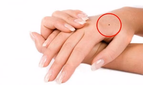 3 vị trí nốt ruồi trẻ kiếm tiền đầy túi, từ 40 hưởng thụ an nhàn - Hình 2 3 vi tri not ruoi tre kiem tien day tui, tu 40 huong thu an nhan-Hinh-2