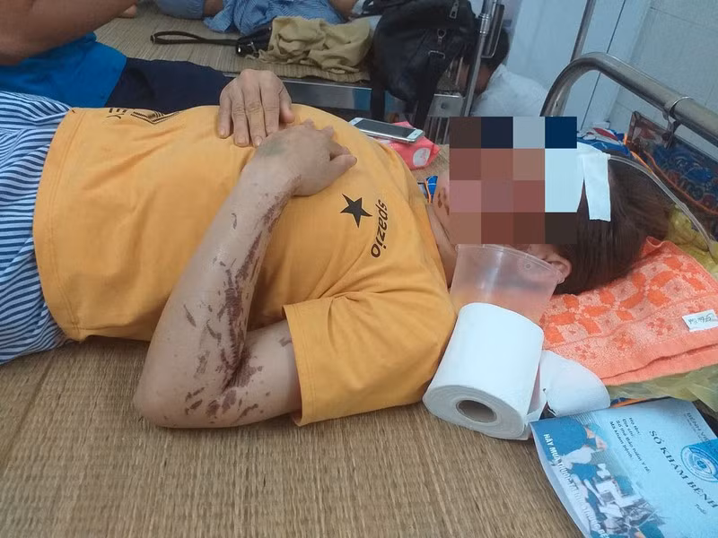 Doi tuong tat axit vao nhan vien phu bep o Hoa Binh da ra dau thu