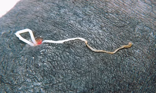 Hình ảnh ghê rợn cho thấy con giun ký sinh bị kéo ra khỏi da của người nhiễm giun chỉ Dracunculiasis.