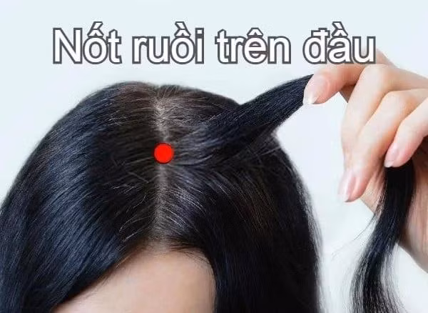 Nốt ruồi trên đỉnh đầu. Người có nốt ruồi trên đỉnh đầu mang tướng phú quý, cát tường, có thể gặp dữ hóa lành, biến hung thành cát.