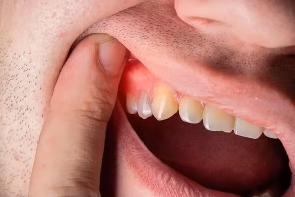 3 mau sac o rang la dau hieu canh bao benh-Hinh-2