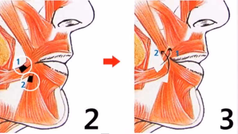 Phần cơ sẽ được các bác sĩ dùng dao kéo can thiệp để kéo cao lên, tạo khóe miệng hình môi cười.