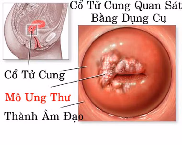 Thực tế, thủ tục sàng lọc không mất nhiều thời gian nhưng chỉ tính riêng ở Anh, trên 20% chị em chưa thực sự chú ý đến sức khỏe mình dù đã được tuyên truyền rất nhiều.