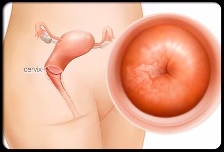 Phương pháp xét nghiệm Pap rất đơn giản, không gây đau đớn và sang chấn cho người được thực hiện. Nó cho phép phát hiện những tế bào có dấu hiệu bất thường nhưng chưa phải là tế bào ung thư; những tổn thương này được gọi tổn thương tiền ung thư.