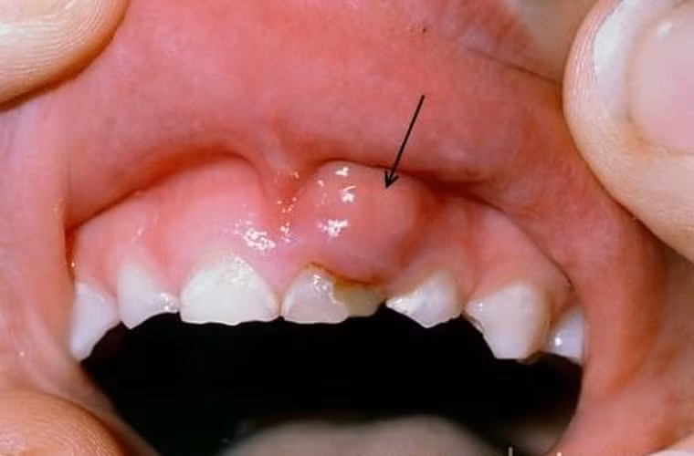 Kiểm tra răng và nướu. Người mắc ung thư miệng còn gặp triệu chứng răng, nướu răng sưng vù, đỏ, nổi cục trong thời gian dài. Đối với người sử dụng răng giả, các vấn đề về nướu sẽ khiến chiếc răng nhân tạo không còn đáp ứng được nhu cầu ăn nhai.