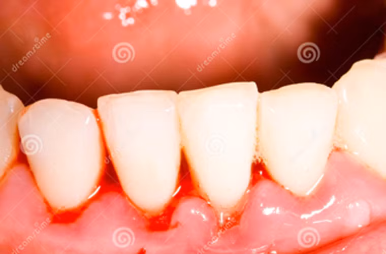 Tìm hiểu căn nguyên gây chảy máu miệng. Một số trường hợp, khối u phát triển về kích cỡ và có thể biến chứng thành vết loét mở, rỉ máu khiến miệng cảm thấy tanh nồng và khó chữa lành dù đã dùng thuốc.