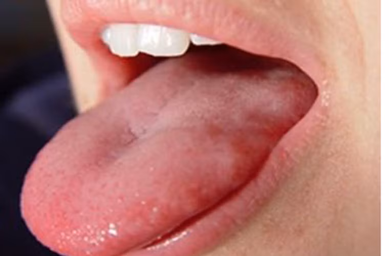 Cảnh giác với hiện tượng lưỡi cứng hoặc ngứa ran. Các vấn đề về lưỡi gây nên tình trạng khó kiểm soát khi nói chuyện hoặc ăn uống. Thậm chí, nó có thể gây khó khăn trong việc nuốt thức ăn dạng đặc, lỏng.