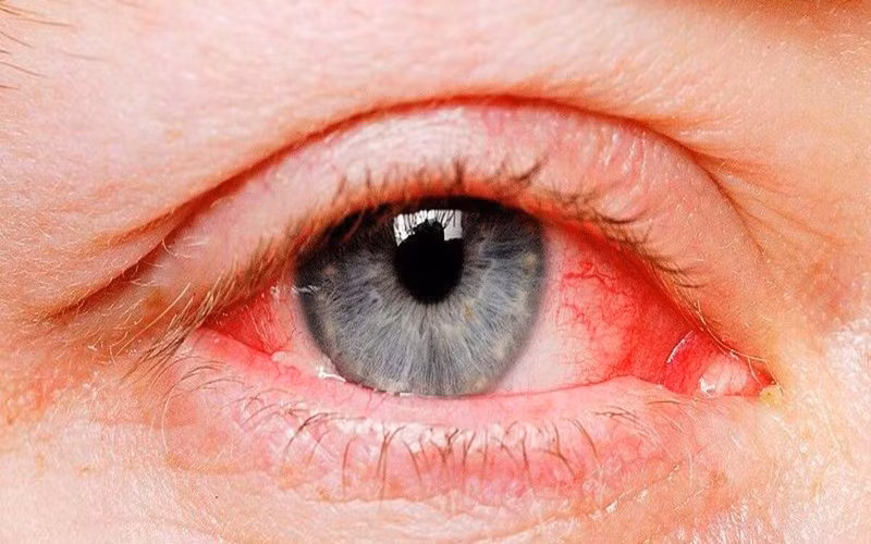 Mắt: Virus corona có thể làm đỏ mắt, gây đau mắt đỏ hoặc viêm kết mạc ở một số bệnh nhân.
