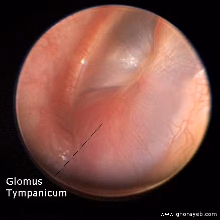 2. Khối u glomus phát sinh từ cấu trúc đặc biệt phía sau màng nhĩ, và được giới hạn trong tai (glomus tympanicum) hoặc có thể lây lan vào cổ (glomus jugulare). Mặc dù lành tính và phát triển chậm, khối u glomus có thể phá hủy các chức năng quan trọng của tai, làm tê liệt mặt, và thậm chí lan đến não nếu không được điều trị.
