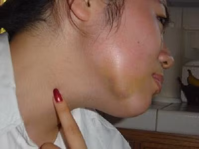 3. Sưng hàm: Sự phát triển của khối u ác tính trong các hàm không chỉ gây đau đớn cùng cực mà còn dẫn đến sưng hàm.