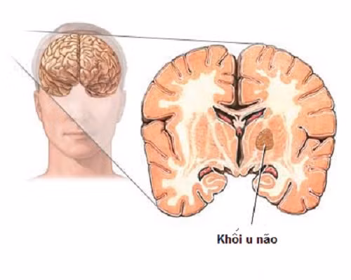 U nguyên bào tủy là một trong những khối u não ác tính ở trẻ em.