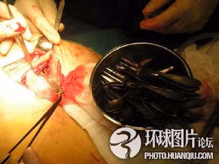 Các bác sĩ phẫu thuật đã tìm thấy hơn 20 chiếc thìa kim loại trong bụng một phụ nữ