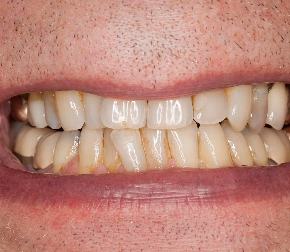 Mảng bám răng có thể trở nên cứng và vôi hóa nếu không được làm sạch bằng bàn chải đánh răng.