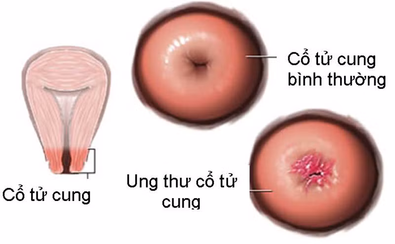 Lúc này, chú ý quan sát dịch cổ tử cung. Bình thường, dịch cổ tử cung trơn, màu trắng nhạt hơi dính. Nếu thấy dịch có màu giống như mủ, dịch có lẫn máu, màu nước gạo hay loãng như nước… cần lưu ý. Đặc biệt, nếu dịch lẫn máu, bạn nên cảnh giác nguy cơ u cổ tử cung.